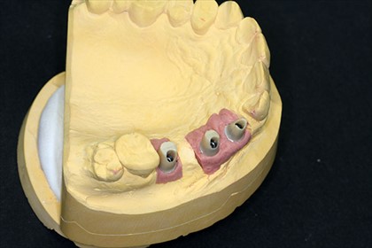 ZirkonAbutments_1.JPG