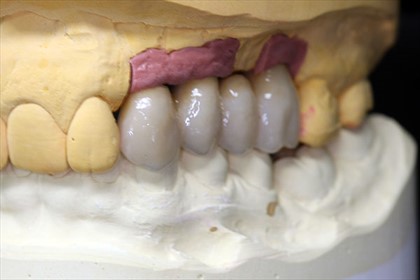 ZirkonAbutments_2.JPG